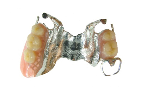 金属床義歯画像