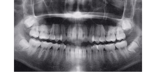 口腔内X線画像