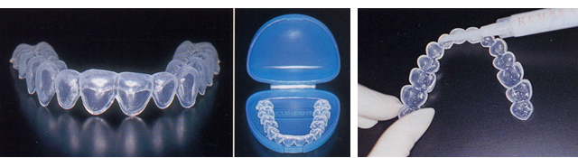 ホワイトニング用マウスピースと薬剤注入