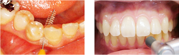 歯の清掃・クリーニング
